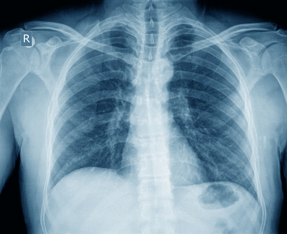 Sieht Man Beim Thorax Röntgen Die Speiseröhre www.tittus-wenk-ibarra.de
